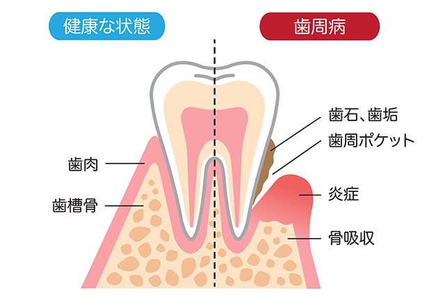 歯周病と健康な歯の状態