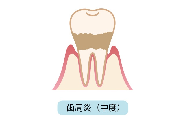 歯周炎（中等度）