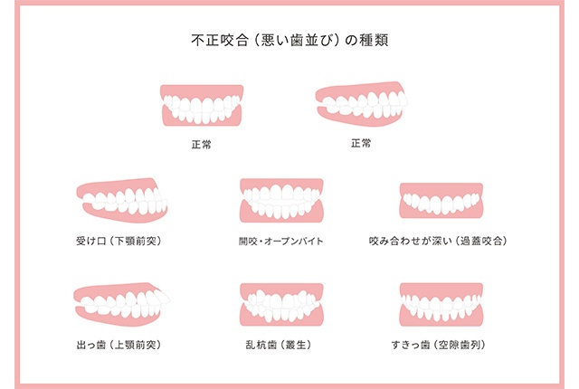 あなたの歯並びはどれですか？